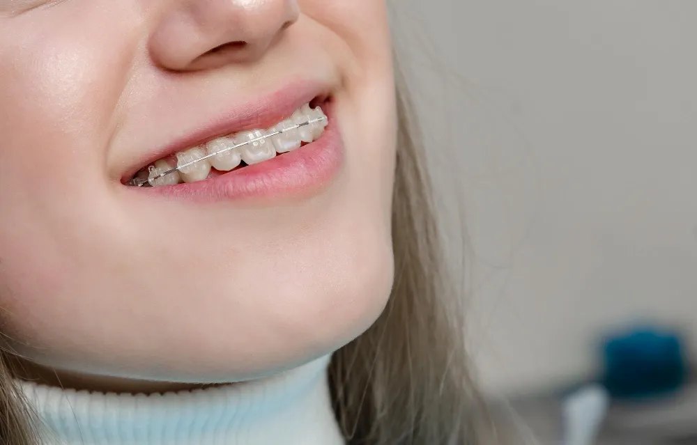 Şeffaf Braket 3