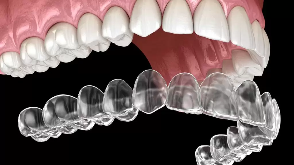 Invisalign 3