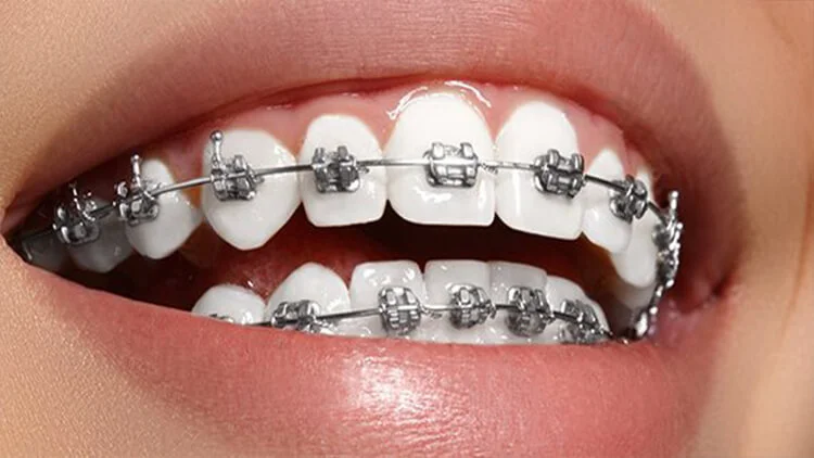 Metal Braket
